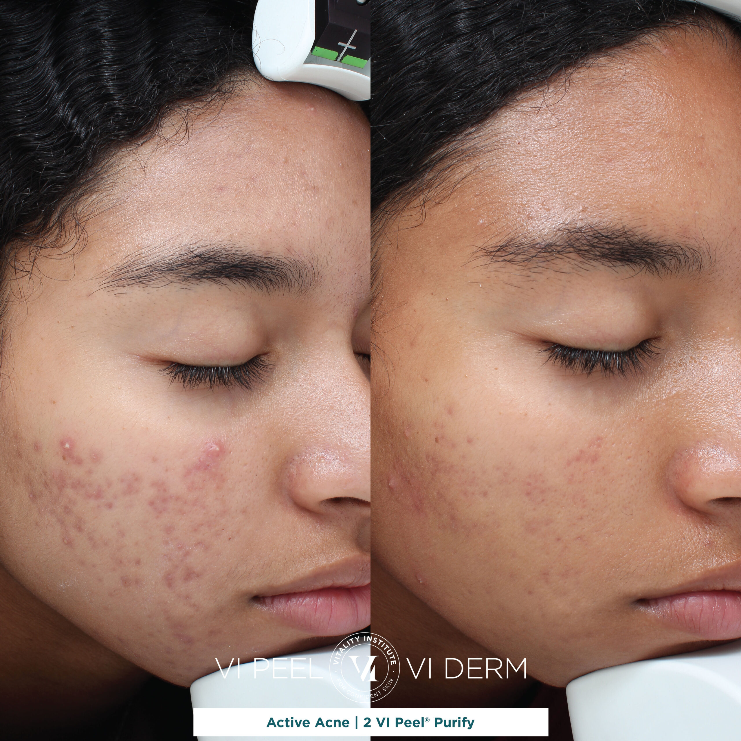 Active Acne 2 VI Peel Purify Graphic Active Acne 2 VI Peel Purify Graphic
