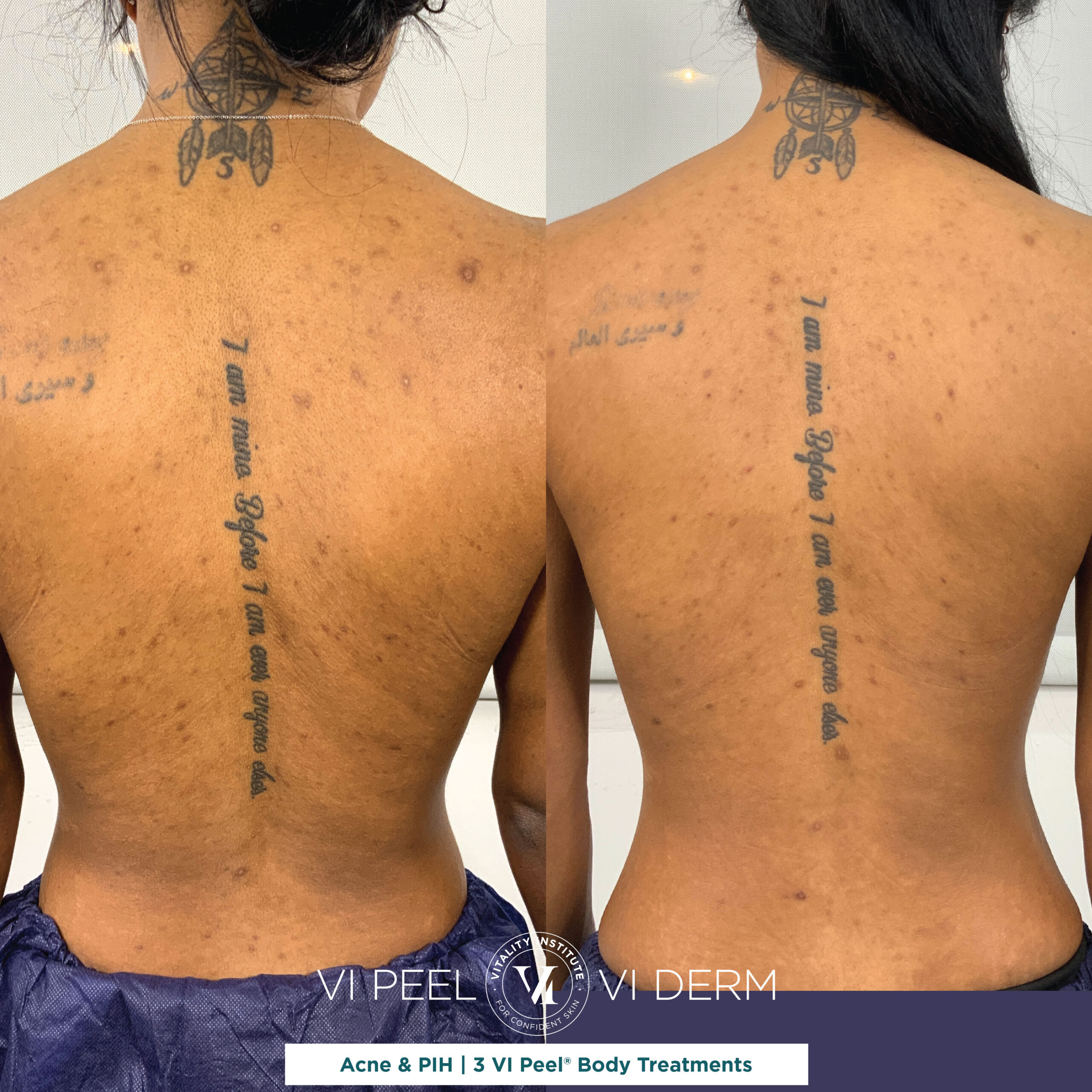 D. Parkes 4 VI Peel Body Back Acne RATING B D. Parkes 4 VI Peel Body Back Acne RATING B