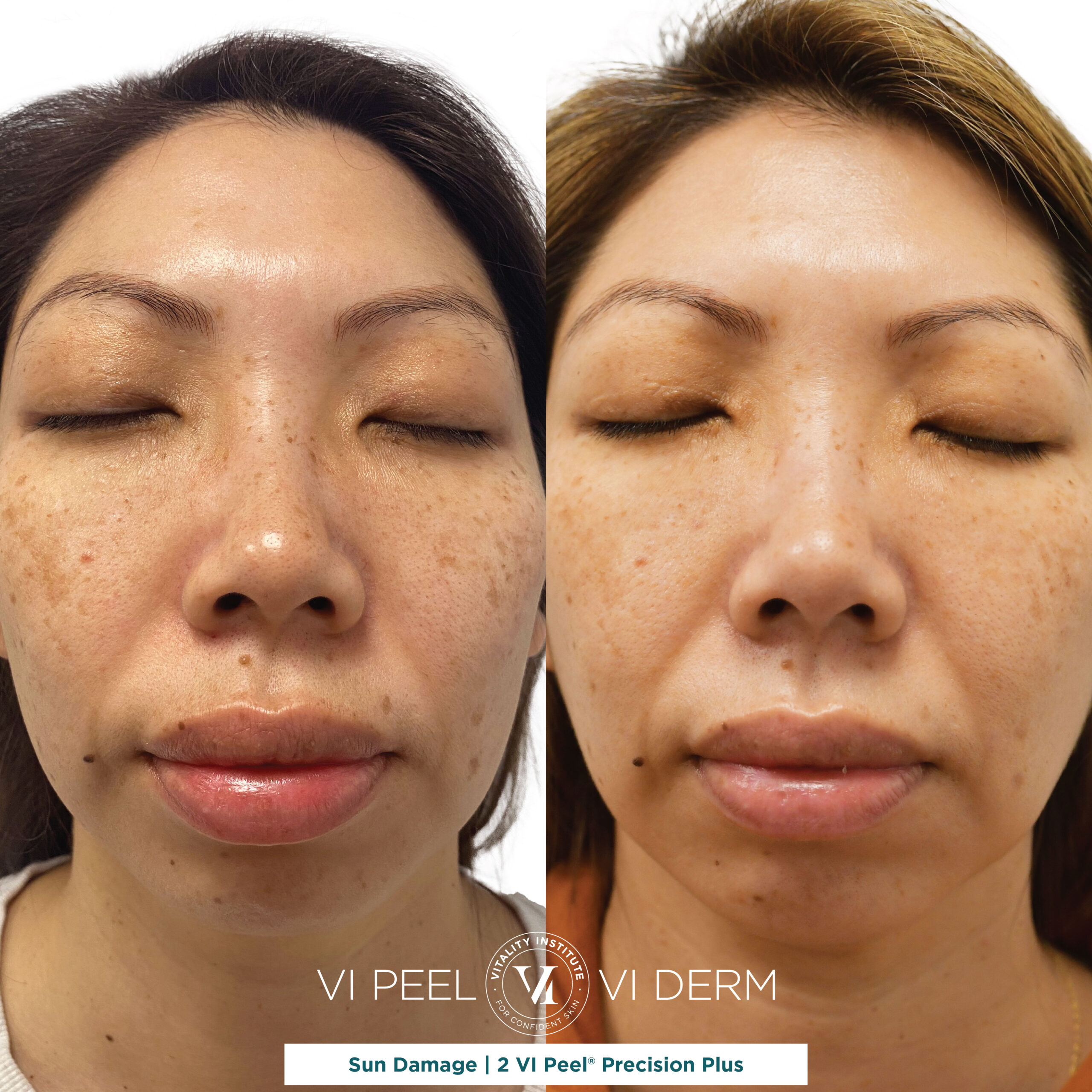 JV 2 Precision Plus Sun Damage Graphic JV 2 Precision Plus Sun Damage Graphic