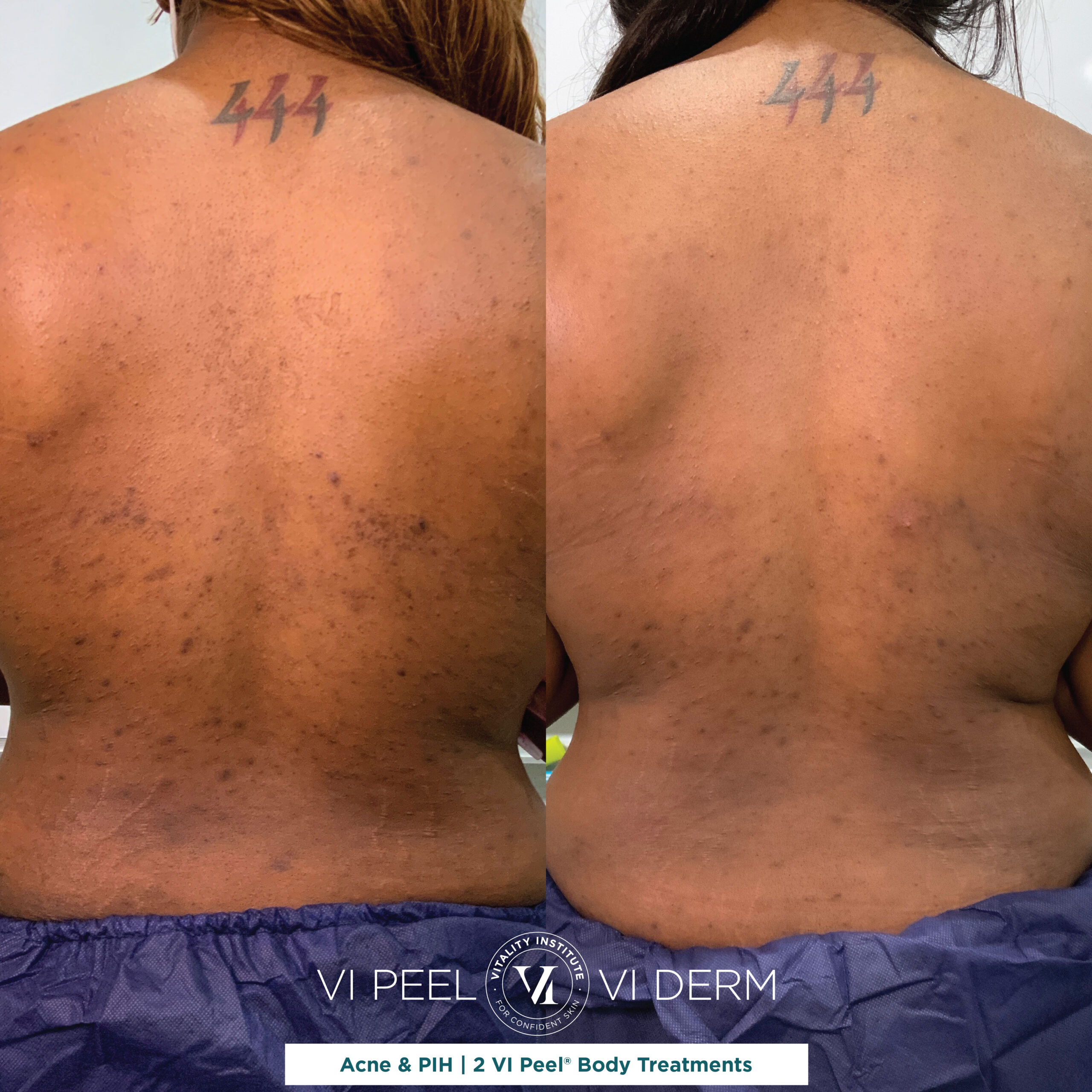 Jakella P 2 VI Peel Body Back Acne RATING A Jakella P 2 VI Peel Body Back Acne RATING A