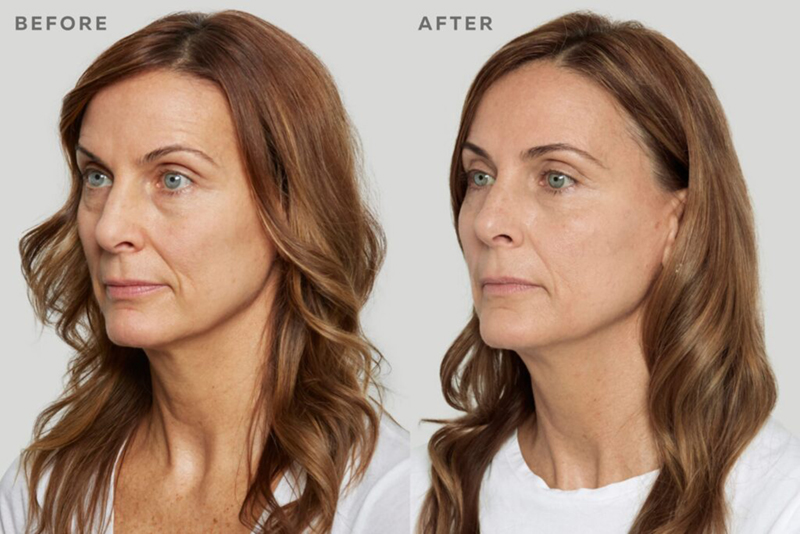 Aria Sculptra before and after treatment image